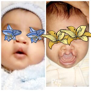 Cleft lip treatment in Hurghada